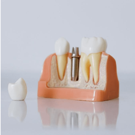 Dental Implants