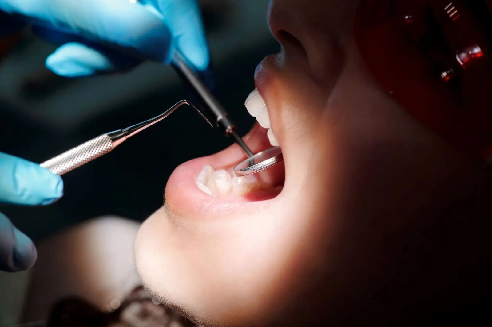 How Much is a Tooth Extraction Cost