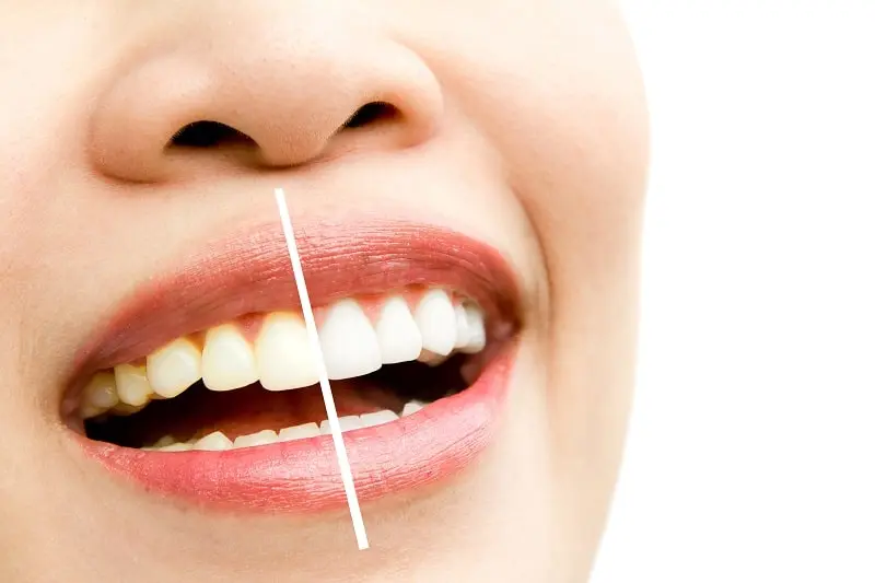 How to Whiten Your Teeth at Home